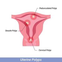 Polyps in the uterus Female reproductive system. Human anatomy internal organs vector