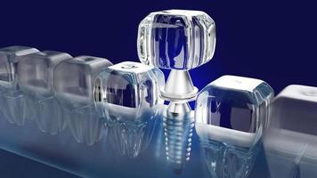 imagen de renderizado 3d de implante dental para contenido médico. foto