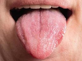 enfermedades de la cavidad bucal, infecciones de la lengua cáncer foto