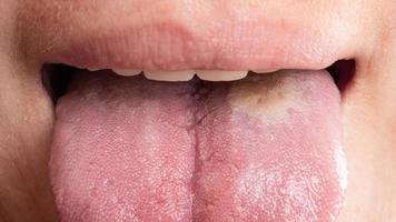 stomatitis inflammation of the tongue, cancer of the tongue photo