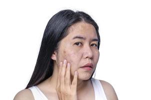 Asian adult woman face has freckles, large pores, blackhead pimple and scars problem from not take care for a long time. Skin problem face isolated white background. Treatment and Skincare concept photo