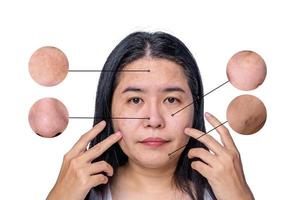 Asian woman face has freckles, large pores, blackhead pimple and scars problem from not take care for long time. Skin problem face isolated white background. Magnifying circles demonstrate problem photo
