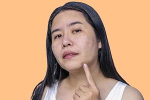 Close up of Asian adult woman face has freckles, large pores, blackhead pimple and scars problem from not take care for a long time. Soft focus of skin problem face. Treatment and Skincare concept photo