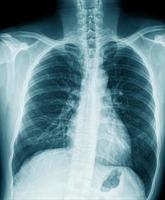 chest x-ray image in blue tone photo