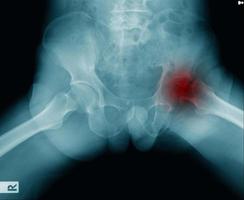 hip fracture at intertrochanteric photo