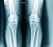 knee joint x ray degeneration photo