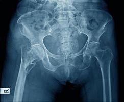 x ray image of pelvic bone photo