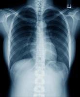 chest x-ray image blue tone photo