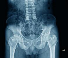 human pelvic bone x ray photo
