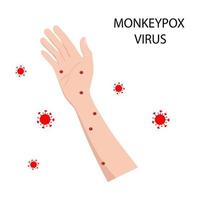 symptom of monkeypox on the human body. Monkey pox. Vector illustration