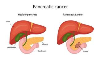 Cancer de pancreas. infografía. ilustración vectorial en estilo de dibujos animados. vector