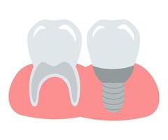 diente sano, limpio, fuerte y un implante instalado en una encía rosa. ilustración dental vectorial para diseño y decoración. vector