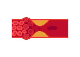 Blood clot, thrombus in vein or artery. Deep vein thrombosis DVT or arterial clot, artery and vein cholesterol sick, abnormally of blood vascular flow. Blocked circulation in blood vessel. Vector