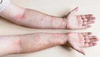 male arms infected by skin disease photo