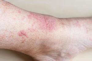 eczema on male shin close up photo