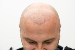 man after hair implant therapy photo