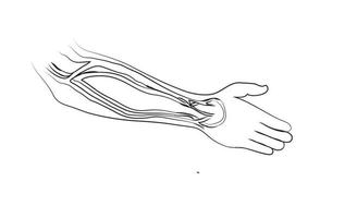 arteriovenous fistula eps vector