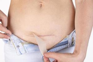 Woman is applying patch with a silicone sheeting on her scar after C-section surgery. Therapy for five months. photo