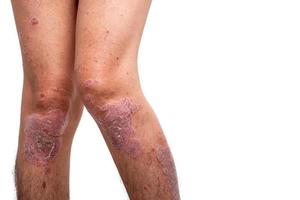 Psoriasis is that knee on white background. photo