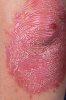 Unrecognizable man feel bad on skin disease called psoriasis. Large red, inflamed, rash on elbows photo