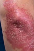 Unrecognizable man feel bad on skin disease called psoriasis. Large red, inflamed, rash on elbows photo