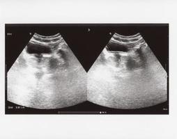 ultrasonido de abdomen completo foto
