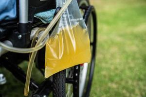 Asian lady woman patient sitting on wheelchair with urine bag in the hospital ward, healthy medical concept photo