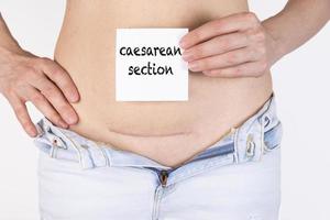 Woman belly with scar and caesarean section text on white sticker. Five months after surgery. photo