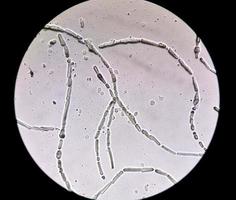 Photomicrograph showing Hyphae of dermatophytes, Nail scraping for fungus test photo