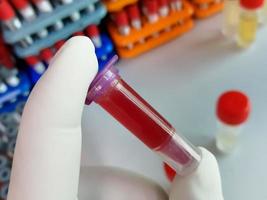 Scientist holding eppendorf with hemolyzed blood sample. Hemolysis sample can cause of false patient report. pre-analytical error. photo