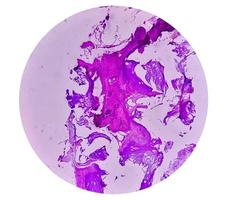 Enchondroma, Benign bone tumor. Microscopic image of enchondroma. photo