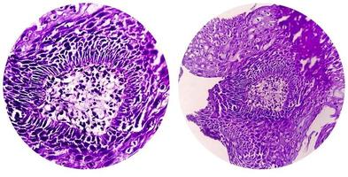 College of Photomicrograph showing Colorectal cancer. photo