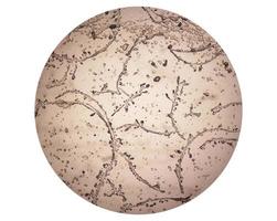 Microscopic image showing Hyphae of dermatophytes,, skin scraping for fungus test photo