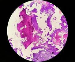 Enchondroma, Benign bone tumor. Microscopic image of enchondroma. photo