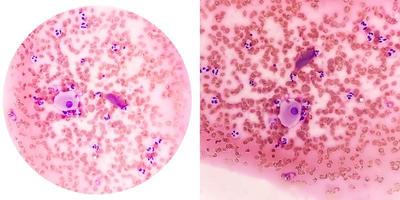 College of two microscopic image showing radiation induced changes. vault smear. photo