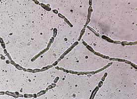 Photomicrograph showing Hyphae of dermatophytes, Nail scraping for fungus test photo