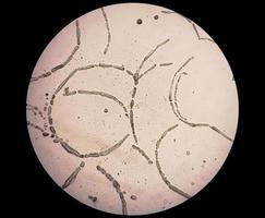 Photomicrograph showing Hyphae of dermatophytes, Nail scraping for fungus test photo