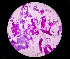 Enchondroma, Benign bone tumor. Microscopic image of enchondroma. photo