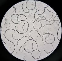 Photomicrograph showing Hyphae of dermatophytes, Nail scraping for fungus test photo