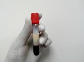 científico o bioquímico sostenga un tubo de ensayo con una muestra de sangre lipémica. triglicéridos altos contienen muestra de sangre. perfil lipídico. foto