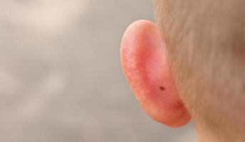 skin sunburnt of child ears from sun close up. back view. summer hot vacation. health and medical concept photo