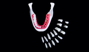 Tooth implant and crown installation process photo