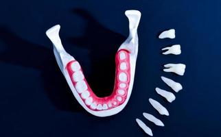 proceso de instalación de implantes dentales y coronas foto