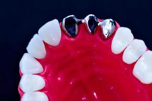 Tooth implant and crown installation process photo
