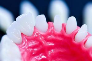 Tooth implant and crown installation process photo