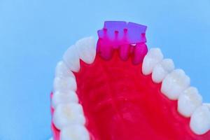 Tooth implant and crown installation process photo