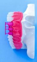 proceso de instalación de implantes dentales y coronas foto