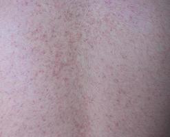 Background of human skin with allergic red spots on back body. photo