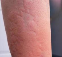 Strong allergic rashes on the body Impaired immunity and reaction to allergenic products. Dermatological rash on the skin and body The problem of health and cosmetology. Immune System Disease, Allergy photo