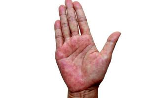 La dermatitis atópica, también conocida como eccema atópico, es un tipo de inflamación de la piel de las manos. foto